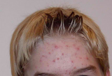 acne_cure_vitamin.jpg