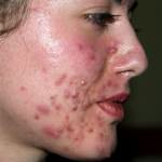 Secrets To Cure Acne with Vitamin A and Zinc, Best Acne Scar Treatment Product